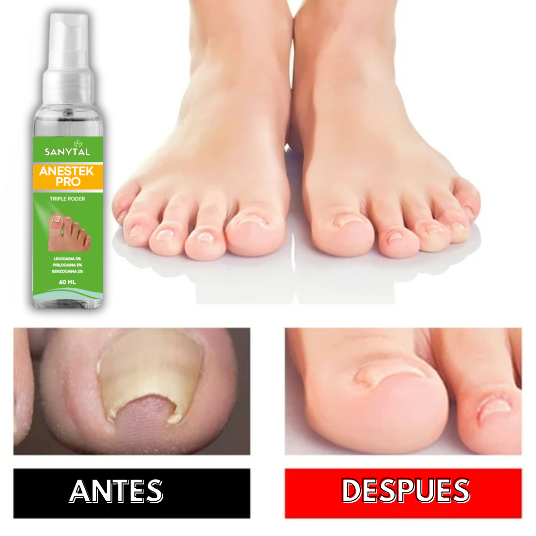 PACK PARA UÑEROS SIN DOLOR - (SPRAY ANESTÉSICO ANESTEK PRO + HERRAMIENTAS PODOLOGICAS) L0202