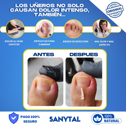 PACK PARA UÑEROS SIN DOLOR - (SPRAY ANESTÉSICO ANESTEK PRO + HERRAMIENTAS PODOLOGICAS) - A01
