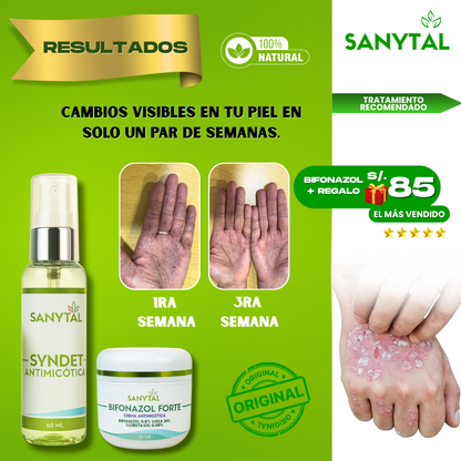 BIFONAZOL FORTE  (ELIMINA TIÑA E INFECCIONES POR HONGO EN LA PIEL)+ JABÓN ANTIMICOTICO SYNDET DE REGALO- B02